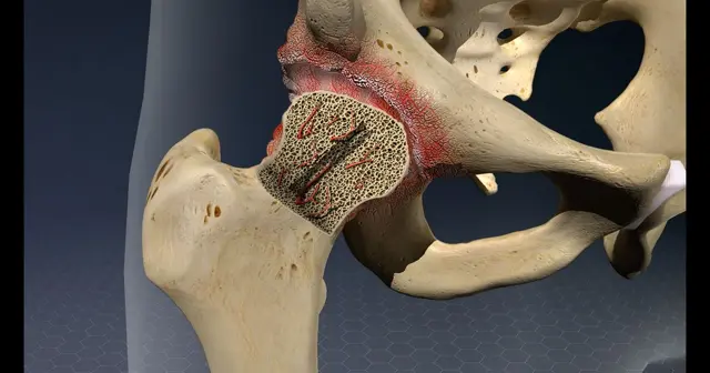 AVN treatment in Bhopal
