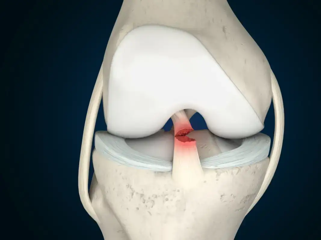 Acl ligament treatment in Jabalpur
