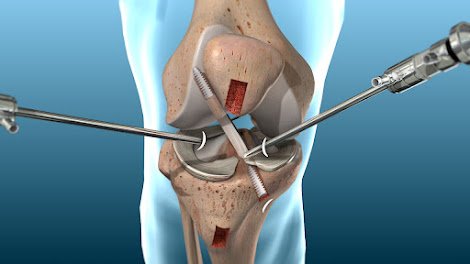 Acl ligament treatment in Bhopal
