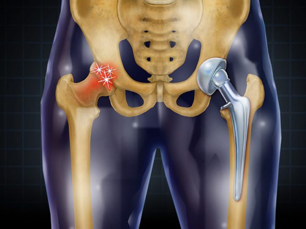 Hip replacement in Gondia
