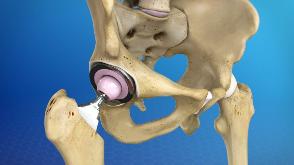 Hip replacement in Bhandara