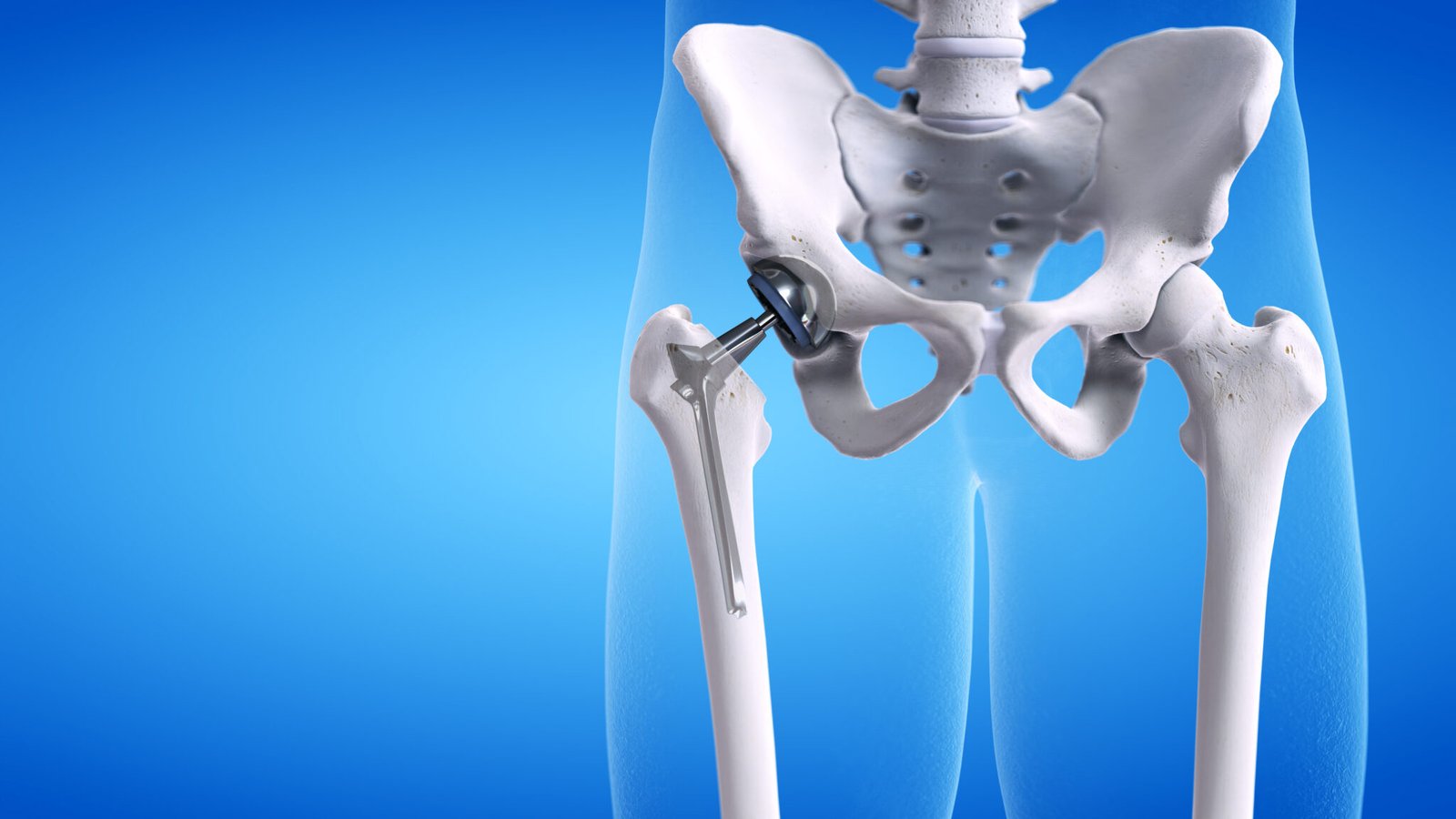 Hip replacement in Sagar