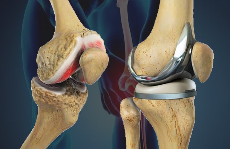 Knee replacement in Adilabad