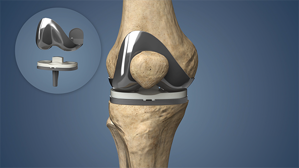 Knee replacement in Yavatmal