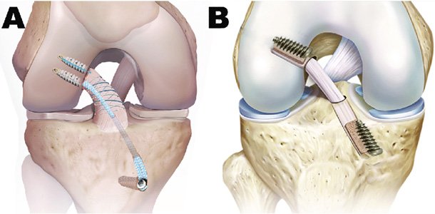 ACL reconstruction surgery specialist in Satna