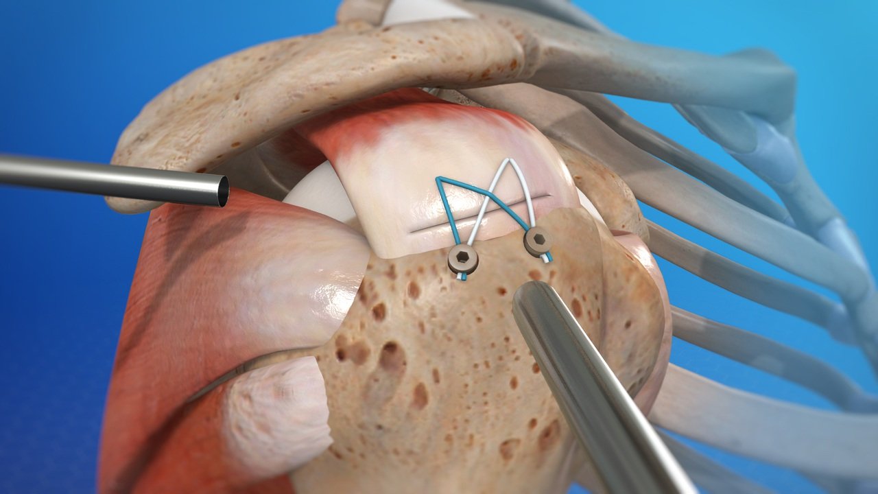 Rotator cuff tear treatment in Satna