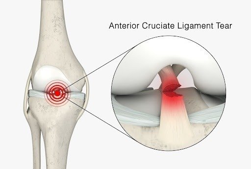 ACL reconstruction surgery specialist in rewa