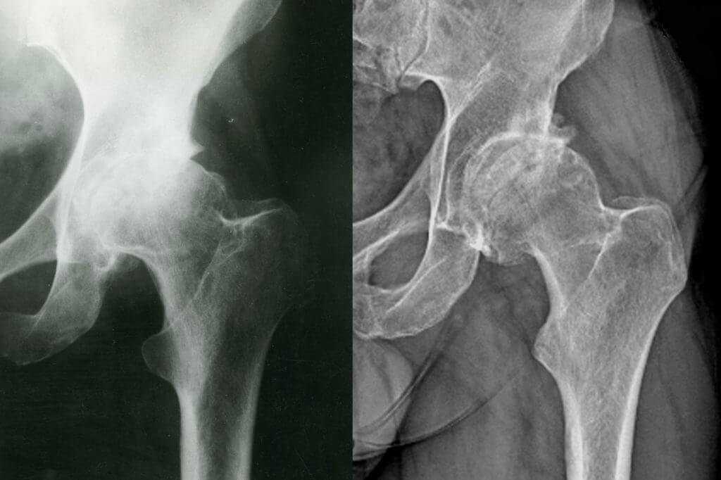 Complex knee replacement in Rewa