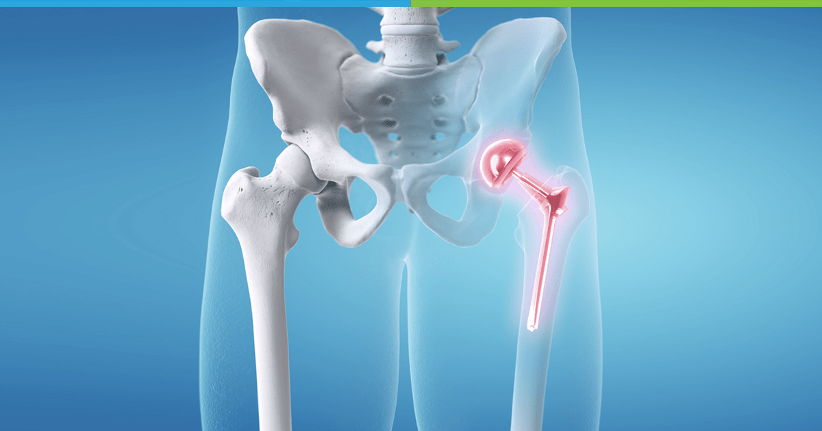 Best hip replacement doctor In Rewa