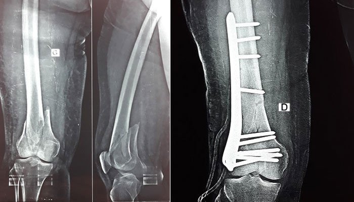 Complex fracture treatment In Nagpur