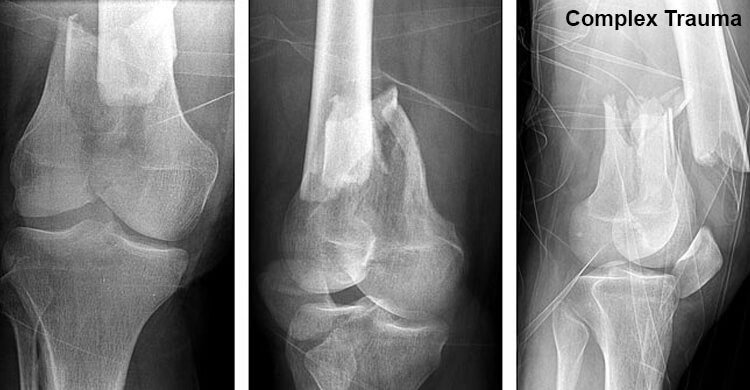 Complex fracture treatment In rewa