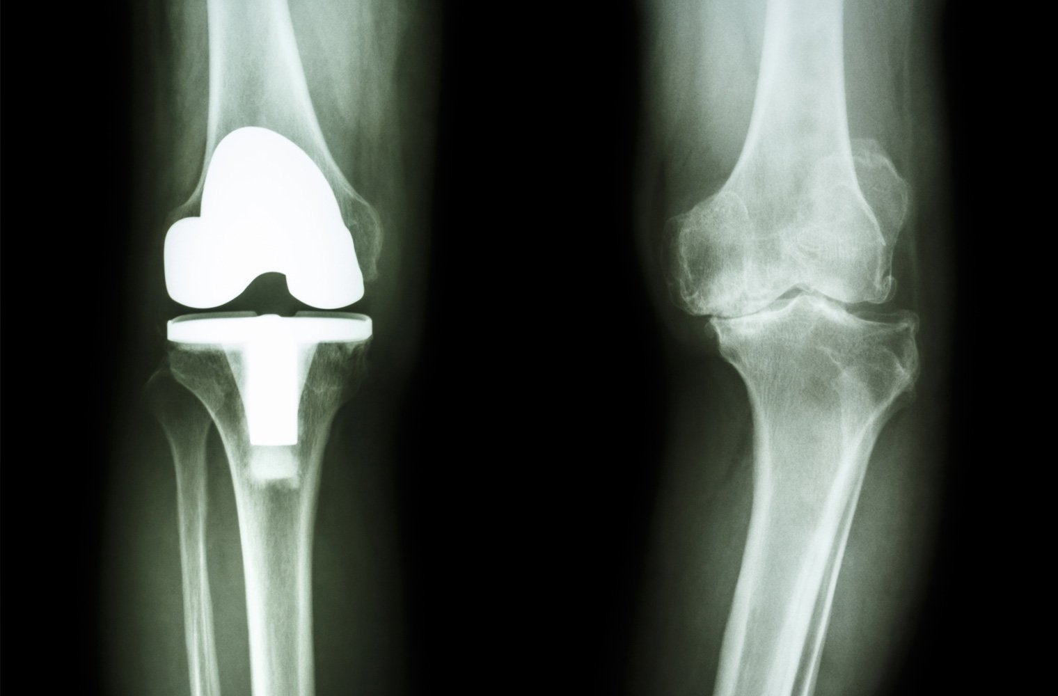 Complex knee replacement in Satna