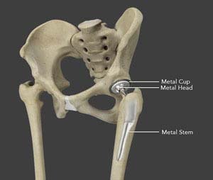 Failed joint replacement correction In Satna