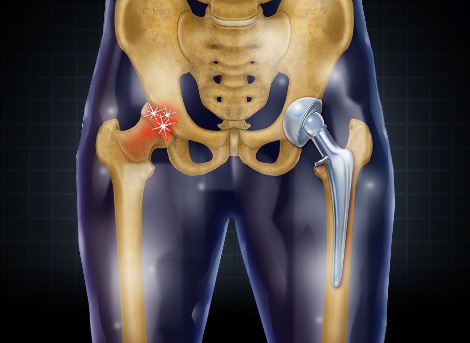 Hip replacement surgery specialist in Satna