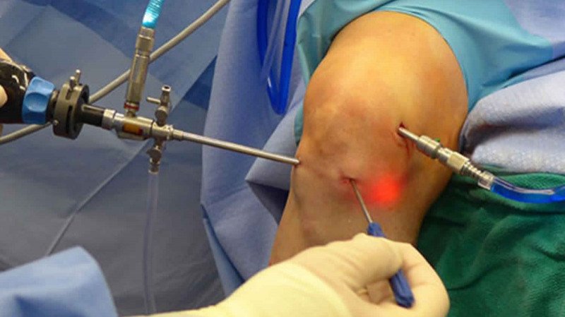 Knee arthroscopy in Rewa