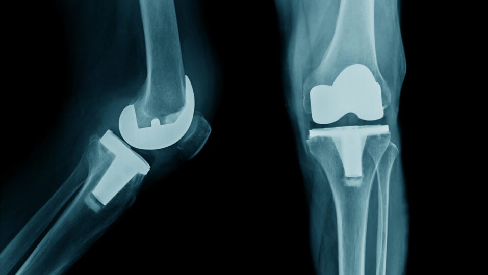 Knee revision surgeon In Nagpur