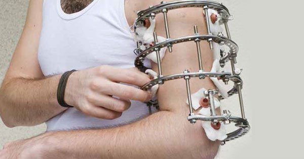 Limb reconstruction surgery in Nagpur
