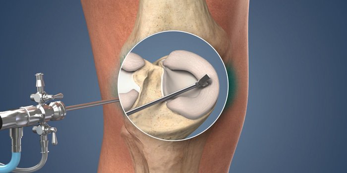 Meniscus repair surgery specialist in nagpur