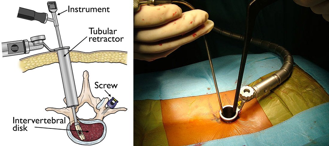 Minimally invasive spine surgery In Nagpur