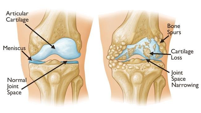 Osteoarthritis knee treatment in Satna