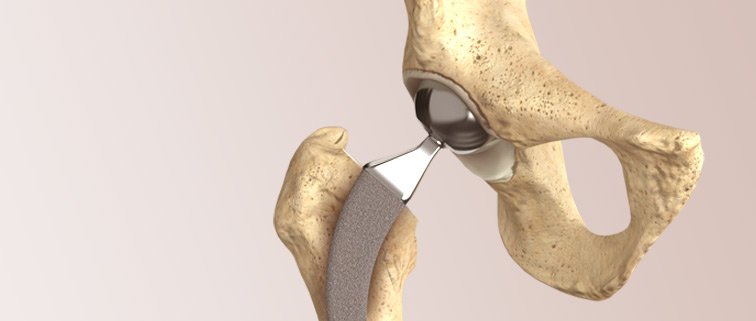 Primary hip replacement in nagpur