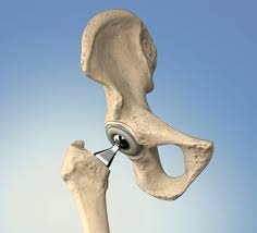 Primary hip replacement in rewa