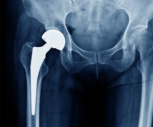Revision hip replacement In Nagpur