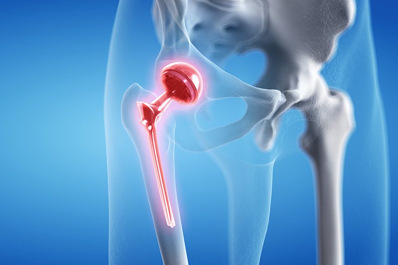 Revision hip replacement In Rewa