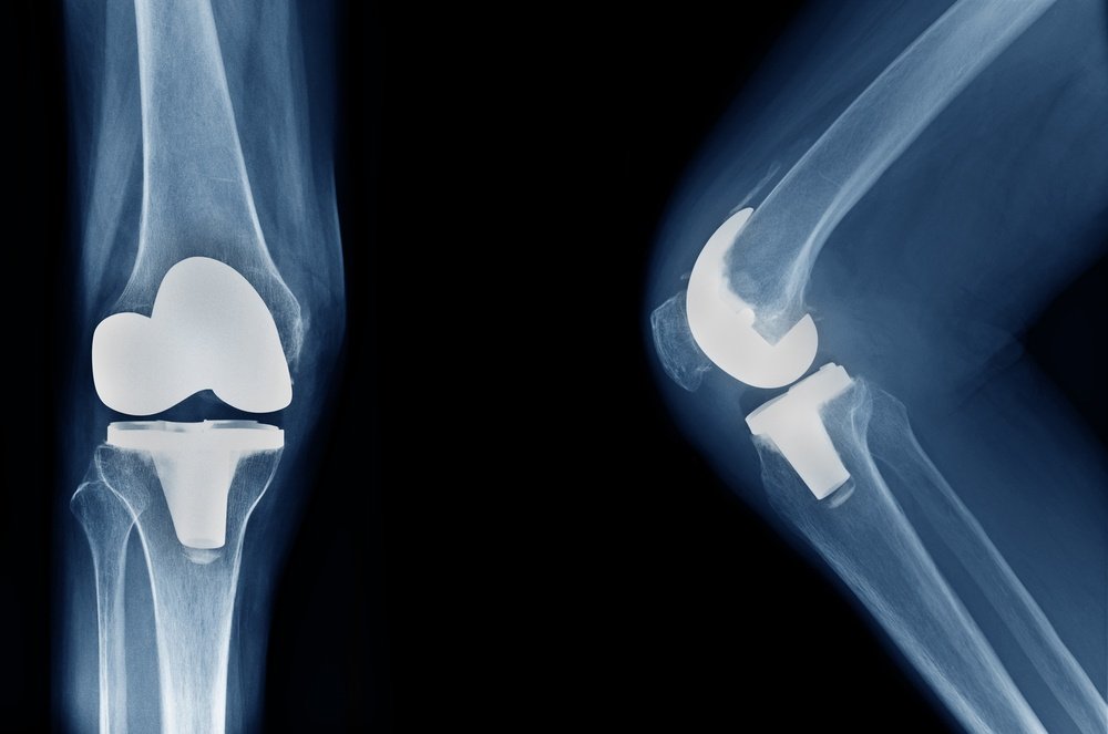 Revision knee replacement In Nagpur