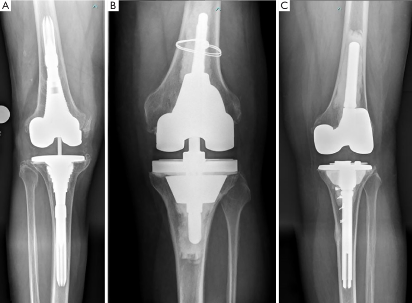 Revision knee replacement In Satna