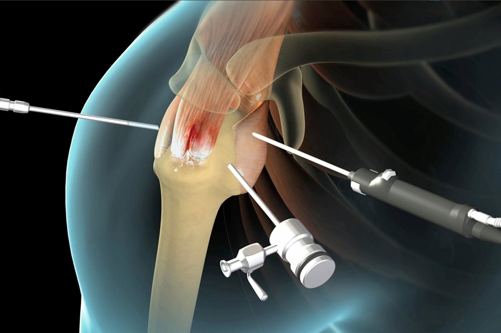 Rotator cuff tear treatment in Nagpur