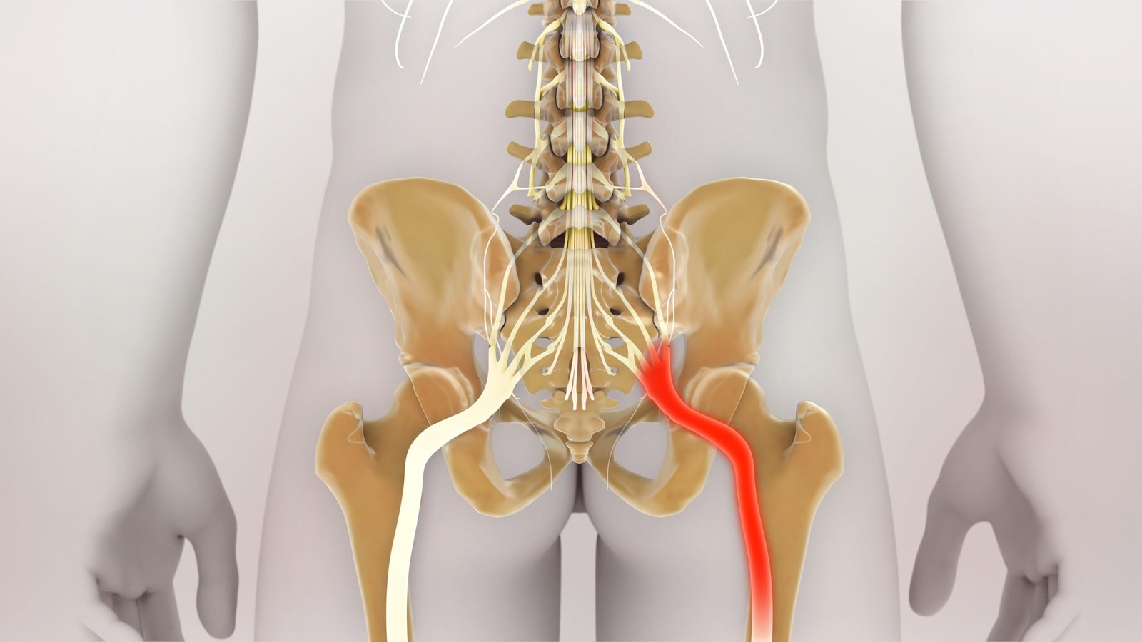 Sciatica surgery Specialist In satna