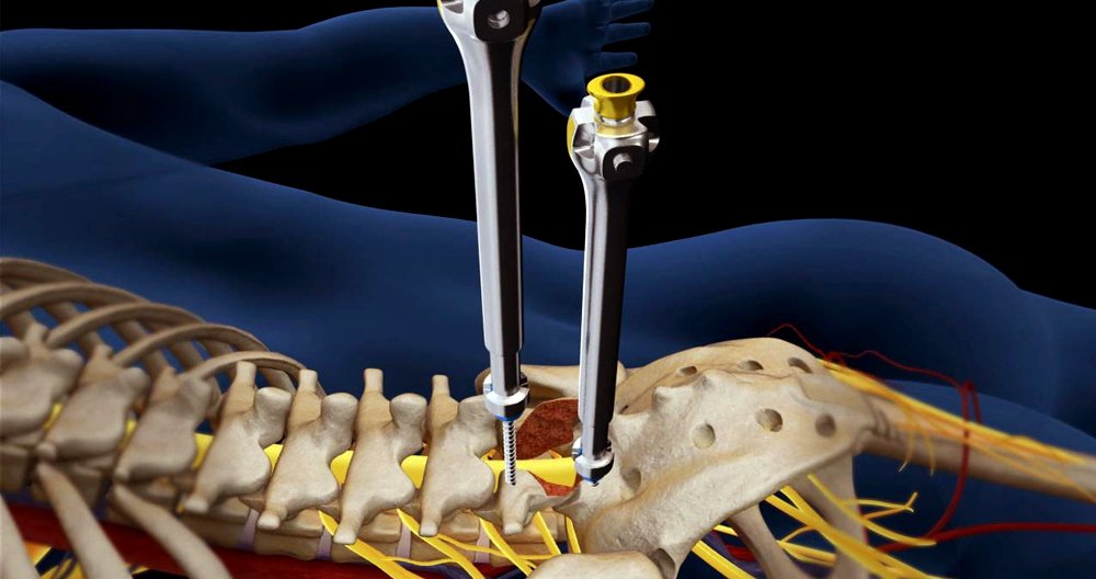 Slipped disc surgery Specialist In Nagpur