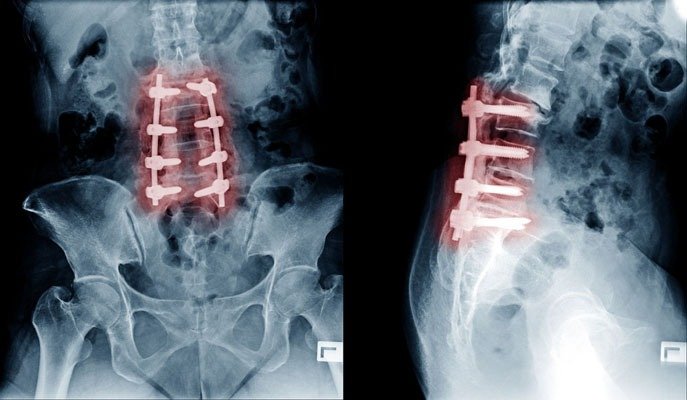 Spine fusion surgery specialist in satna