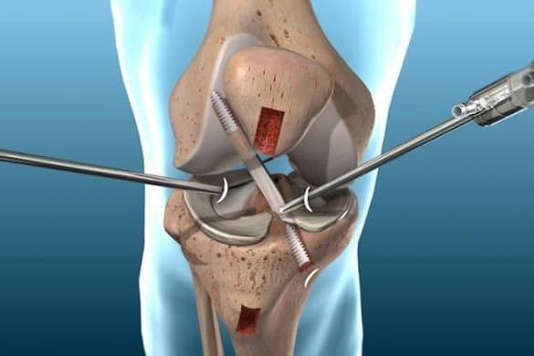 Sports injury arthroscopy In Nagpur