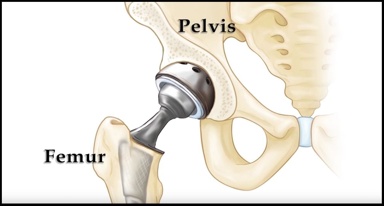 Total hip replacement (THR) in Satna