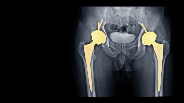 Total hip replacement (THR) in nagpur