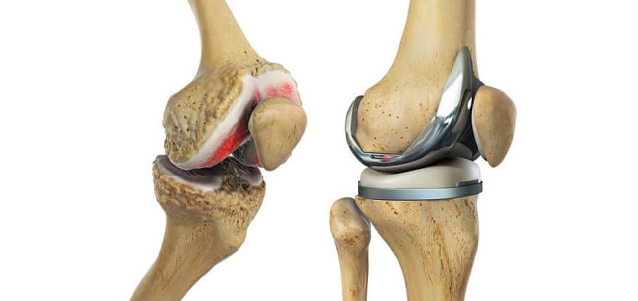 Total knee replacement (TKR) In Nagpur