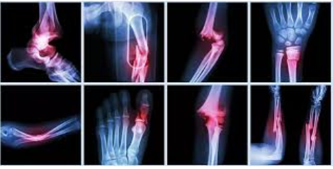 ⁠Fracture surgery specialist in Rewa