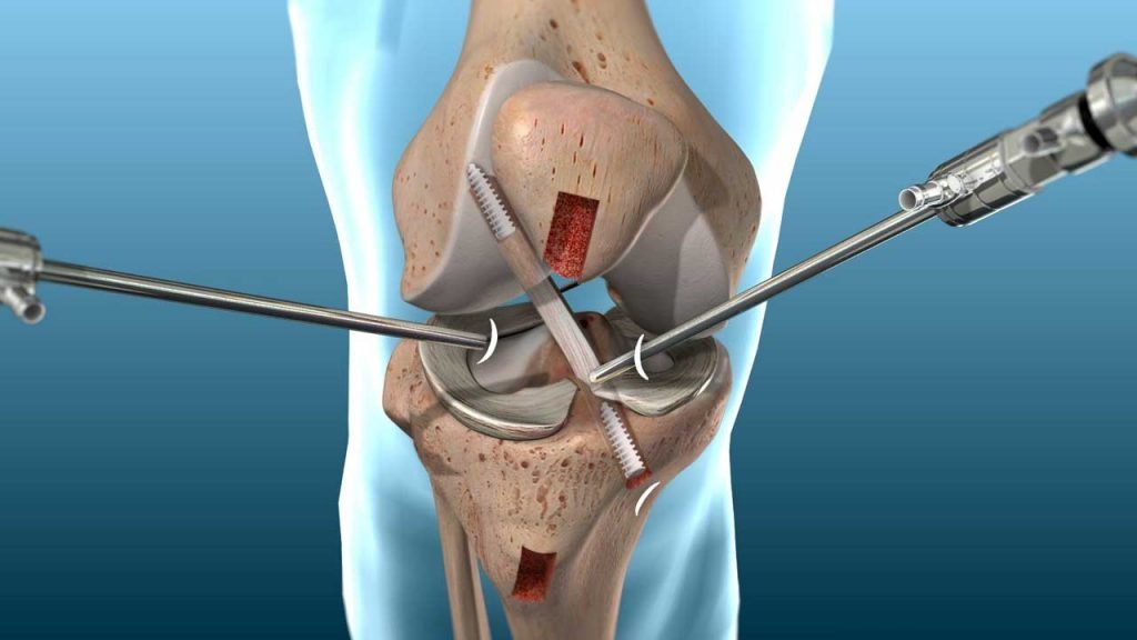 ACL reconstruction surgery specialist in Seoni