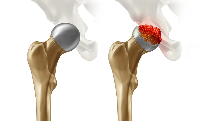 AVN hip treatment in Mandla