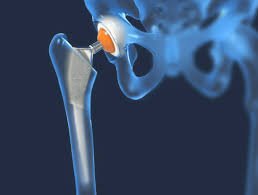 Best hip replacement doctor In Mandla