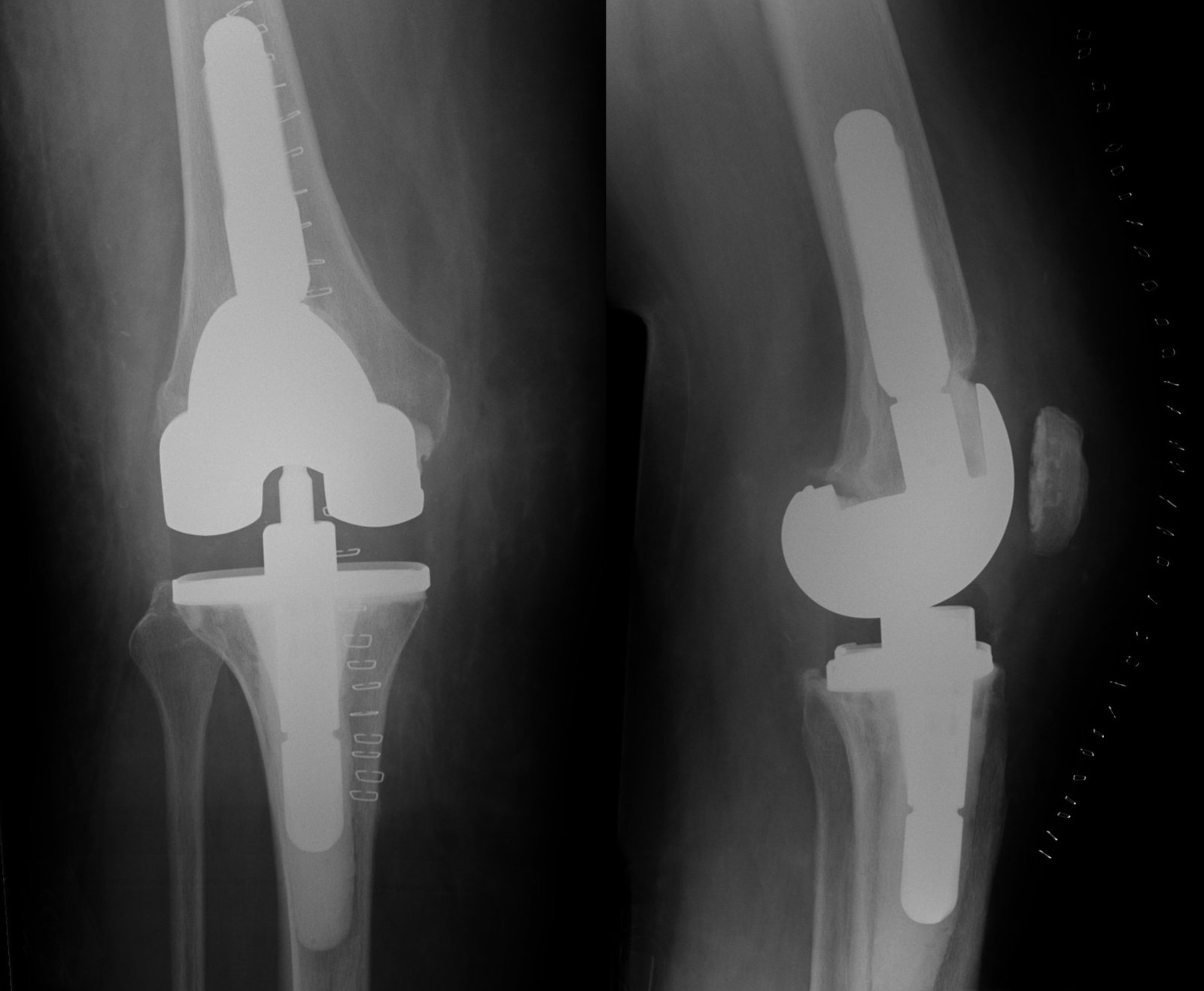 Complex knee replacement in Itarsi