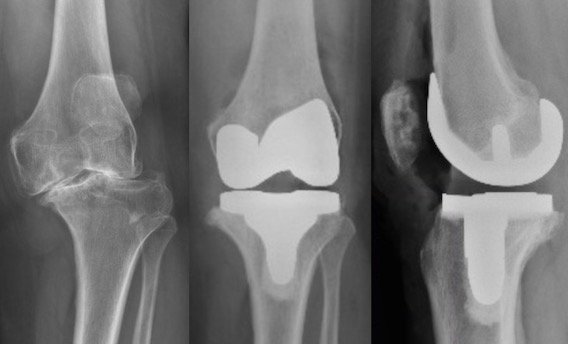 Complex knee replacement in Mandla