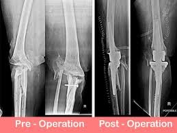 Complex knee replacement in Seoni