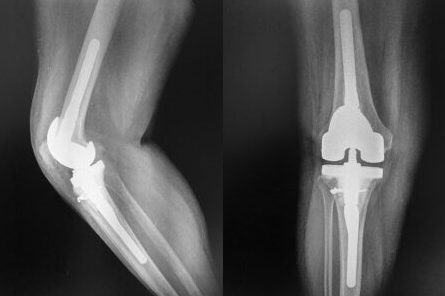 Failed joint replacement correction In Betul