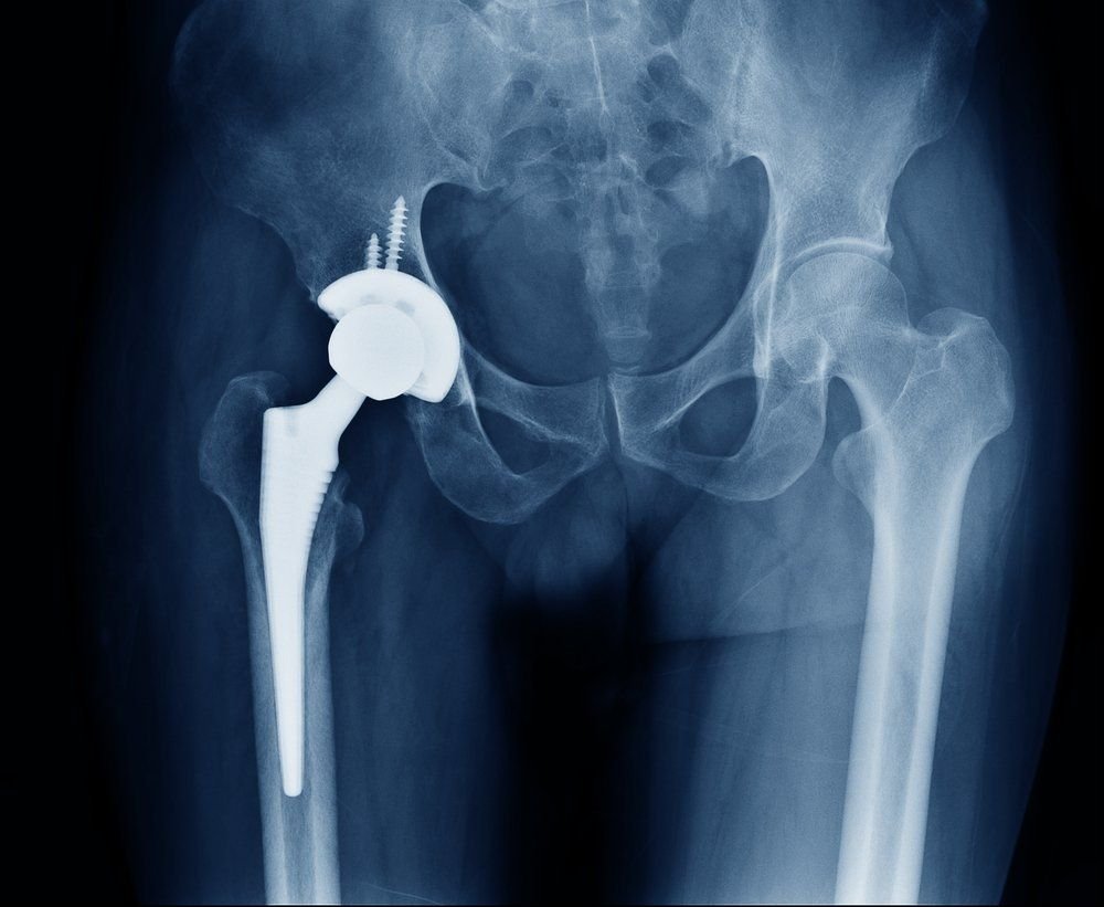 Hip arthritis surgery specialist in itarsi