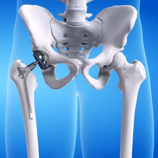 Hip arthritis surgery specialist in mandla