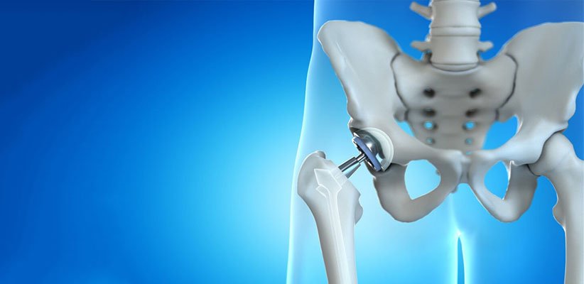 Hip replacement surgery specialist in Betul