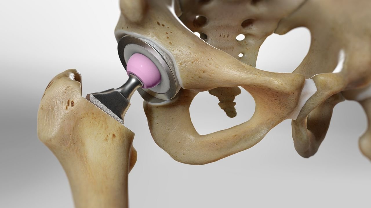 Hip replacement surgery specialist in seoni